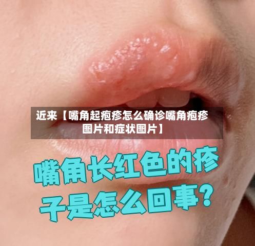 近来【嘴角起疱疹怎么确诊嘴角疱疹图片和症状图片】-第3张图片