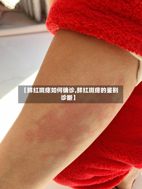 【鲜红斑痣如何确诊,鲜红斑痣的鉴别诊断】
