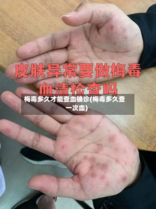 梅毒多久才能查血确诊(梅毒多久查一次血)