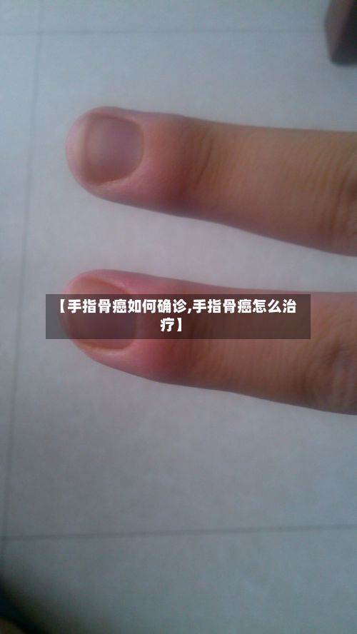 【手指骨癌如何确诊,手指骨癌怎么治疗】