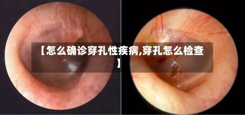 【怎么确诊穿孔性疾病,穿孔怎么检查】
