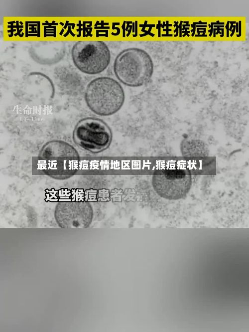 最近【猴痘疫情地区图片,猴痘症状】