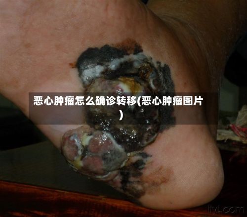 恶心肿瘤怎么确诊转移(恶心肿瘤图片)